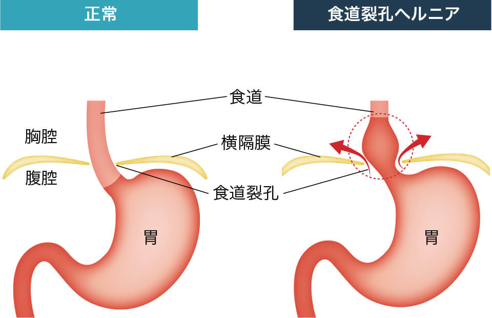 逆流性食道炎を合併しやすい食道裂孔ヘルニア
