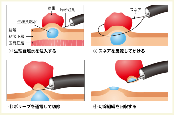 ポリープ生検のリスクは何ですか?