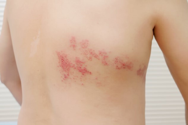 帯状疱疹の皮膚症状